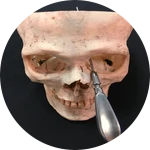 Amateur lobotomy